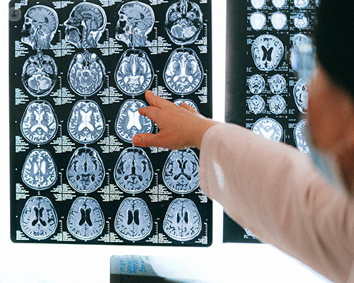 A medical professional pointing at specific parts of a brain scan result