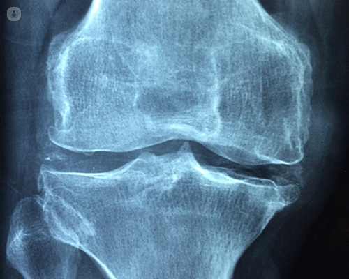 An X-ray scan of a worn out or arthritic knee joint