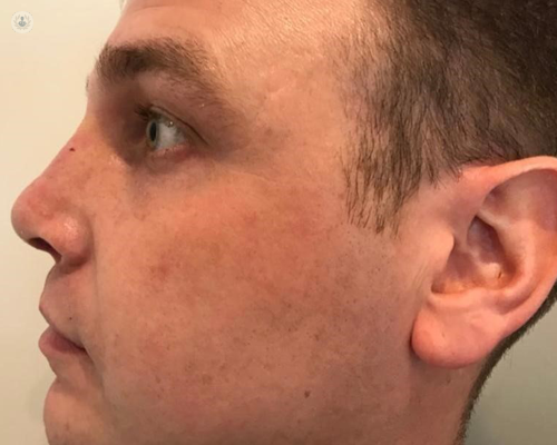 After photo from the side, of a man who has had a nose job