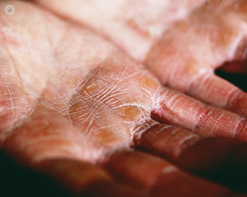 Close up of eczema on hands