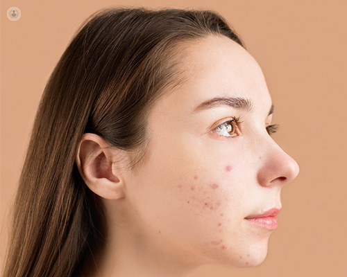 A woman with acne
