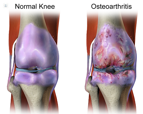 osteoarthritis treatment uk