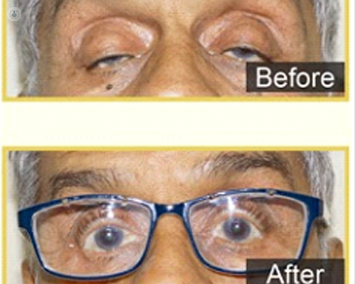 Before and after photos of a male patient who has had ptosis surgery