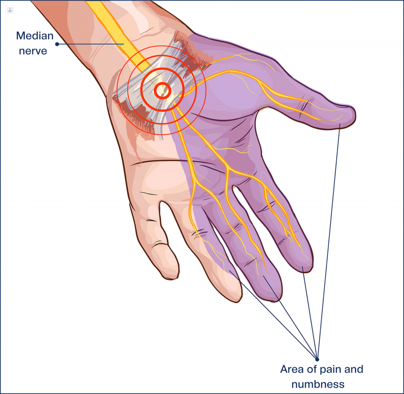 A 2D digitally generated diagram of the wrist and palm of a hand. It shows the median nerve and circles the wrist in red to show where carpal tunnel syndrome occurs