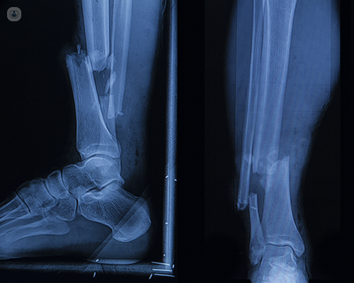 Two right leg x-rays side by side. The left scan of the leg shows side view of a broken bone, whereas the right shows the same break but from the front - the bone is a not stable and broken.
