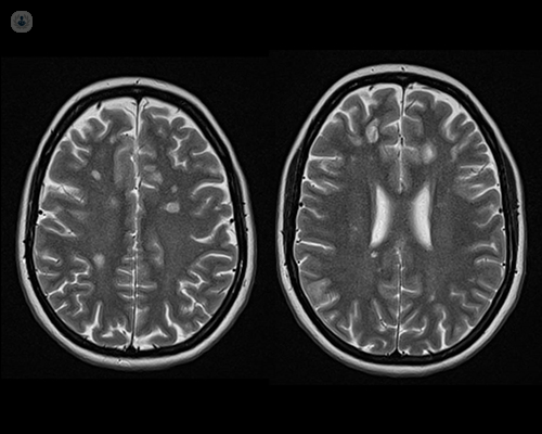 MRI MS scan