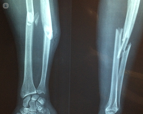 Two arm x-rays side by side. The left shows a stable and non-broken arm whereas the right shows a fractured arm - the bone is a not stable and broken