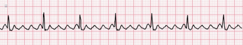 An electrocardiogram result. This shows the rate at which the heart beats. One line travels from the left to right and sharp rises and falls signify the heartbeats,