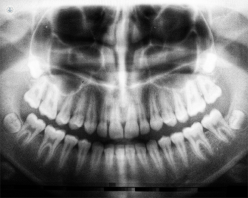 Wisdom teeth X-ray