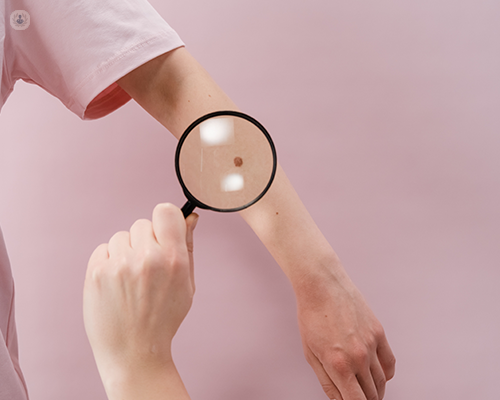 A skin cancer examination on a mole, one of the types of skin lesions that can suggest skin cancer
