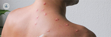 Raised skin from injection sites along a persons neck and upper back during neural therapy