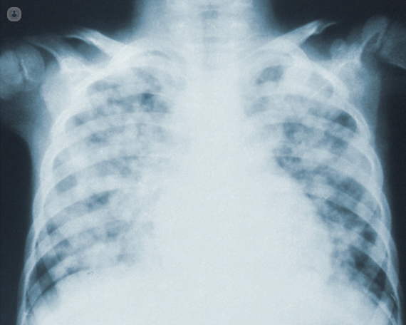 pneumonia-breathing-problems-x-ray