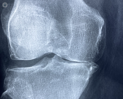 An X-ray of bone-to-bone knee arthritis