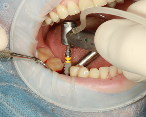 Possible zirconia dental implant being implanted into mouth