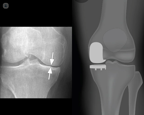 X-ray of a partial knee replacement