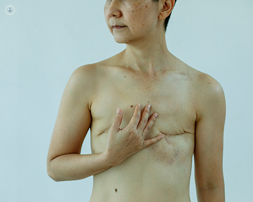 a woman who has undergone a mastectomy procedure
