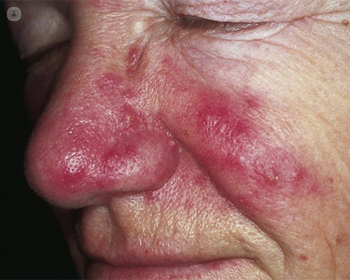 Man with rosacea, that requires laser treatment