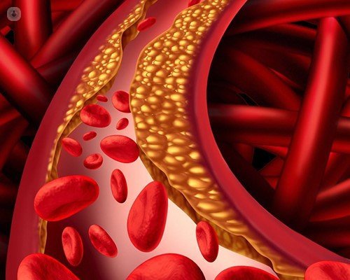 Illustration of coronary arteries that have a build up of fatty material, causing coronary artery disease