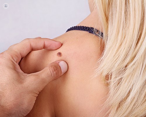 The three most common types of skin cancer