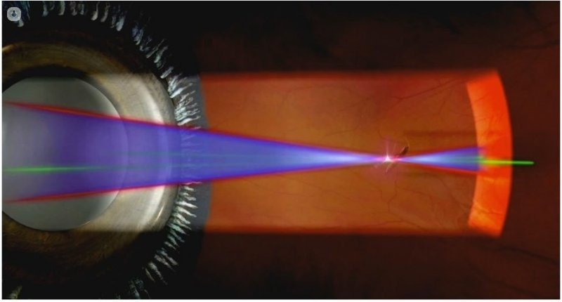 vitreolisis laser