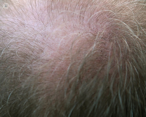 Why am I losing my hair? Telogen effluvium explained