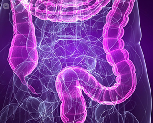 Digital illustration of inflammatory bowel disease  