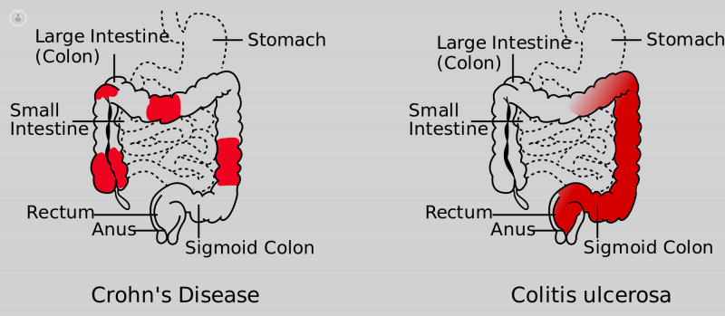 Diagram illustrating the difference between Crohn's disease and ulcerative colitis  