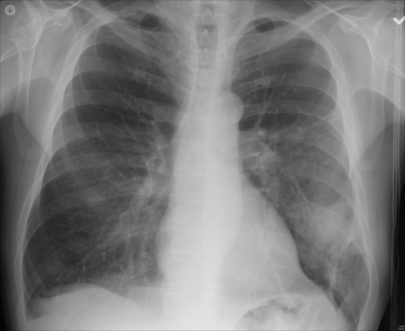 X-ray showing pneumonia    