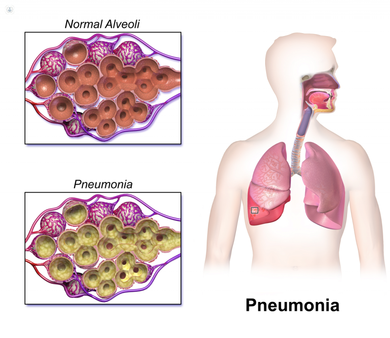 Medical diagram showing the difference between health alveoli and alveoli with pneumonia