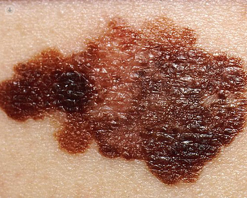 Close up image of a melanoma that has spread on fair skin