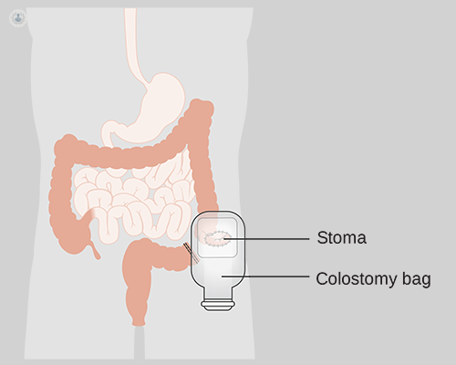 what causes a colostomy bag, SAVE 87% 