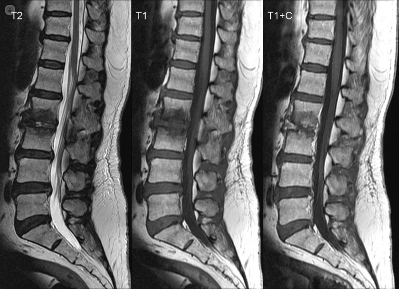 Spine what is it, symptoms and treatment | Top Doctors