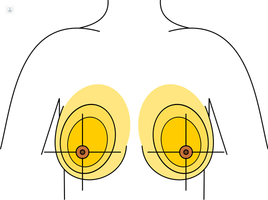 Breast asymmetry: what is it, symptoms and treatment
