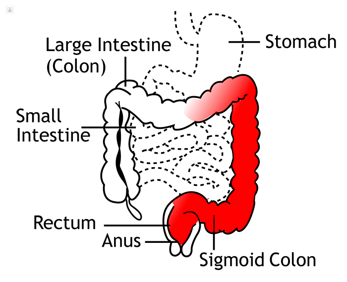 Ulcerative colitis: what is it, symptoms and treatment