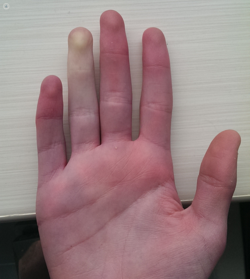 Raynaud S Disease What Is It Symptoms And Treatment Top Doctors