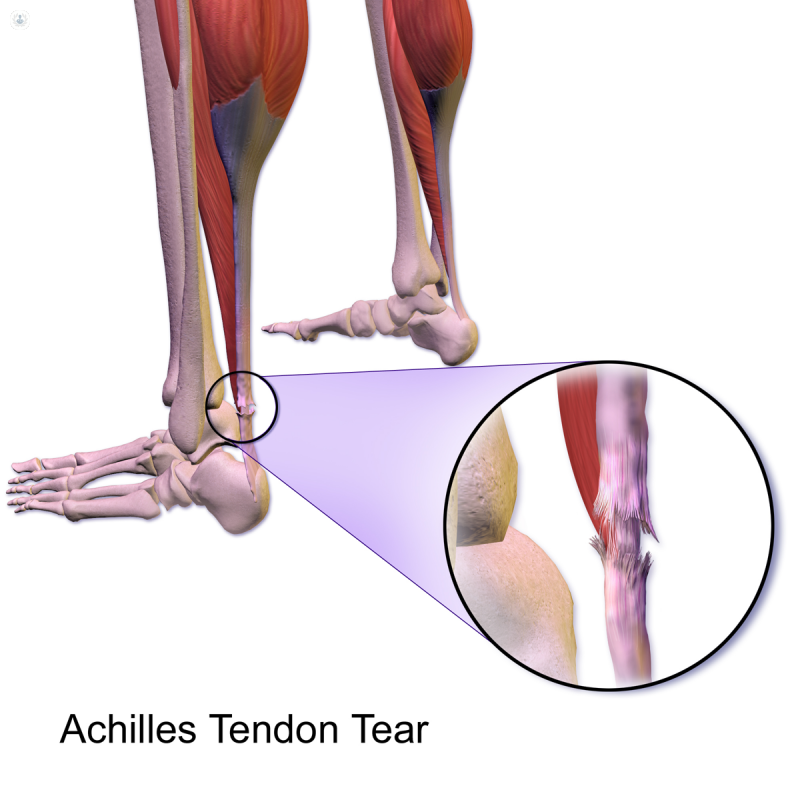 Diagram of Achilles tendon tear