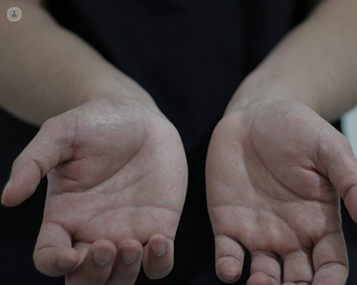 Close up of hands of person with carpal tunnel syndrome