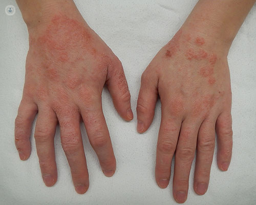 Knowledge Base in the Treatment of Atopic Dermatitis Among Thai Pediatricians
