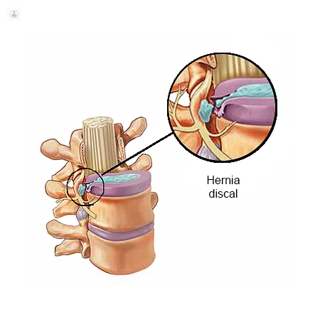 Diagram of herniated disc that requires percutaneous discectomy