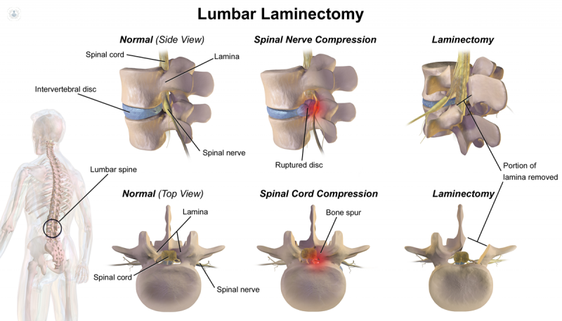 Laminectomy: what is it, symptoms and treatment | Top Doctors