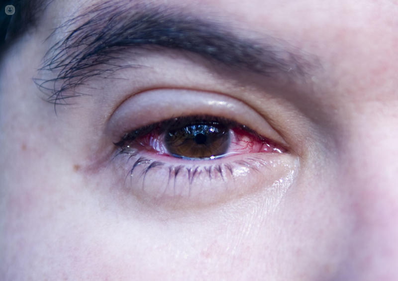 Close up of man with conjunctivitis