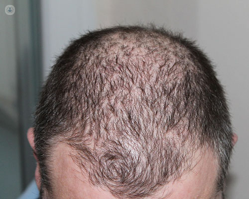 How can male hair loss be treated?