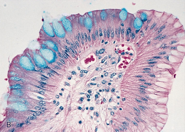 Microscopic image of Barrett's oesophagus 