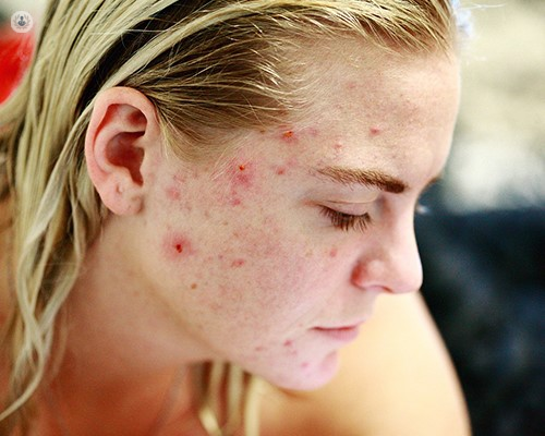 Woman with acne scars looking down