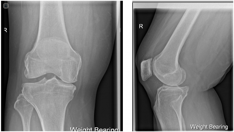 Partial knee arthritis shown in an x-ray
