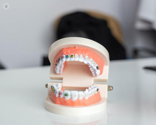 Types of Braces  Oxford Orthodontics