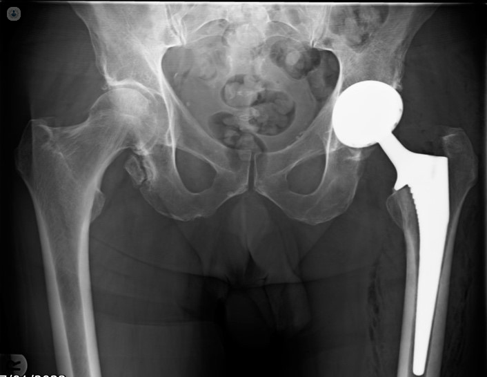 Minimally invasive surgery in a total hip replacement