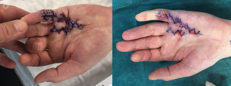 Before and after photo of hand surgery
