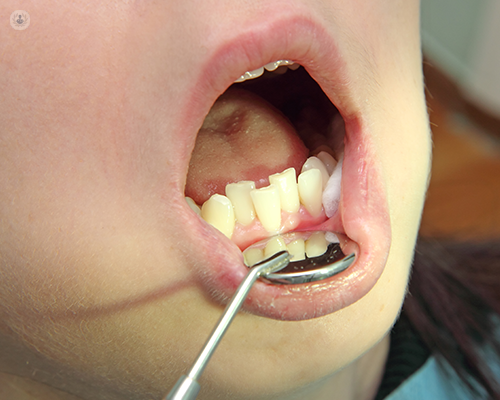 A dental tool being used to view a child's crowded teeth.