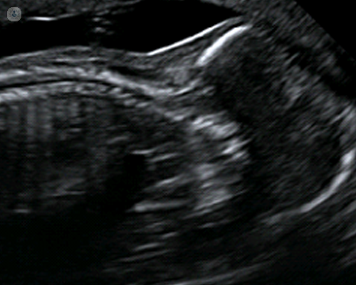 Image of early anomaly scan (14 - 18 weeks)